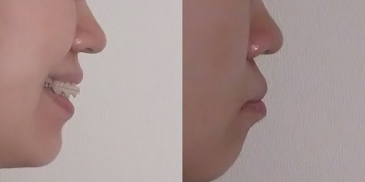 Atelier40 ワイヤー歯列矯正中 歯並びの良い出っ歯 上下顎前突 第二小臼歯抜歯済 歯並びの良い出っ歯あるある 私 歯列矯正始めたんだ えー 別に気にするほど歯並び悪くないよね お金勿体なくない 私 いやいや 横顔ヤバイん