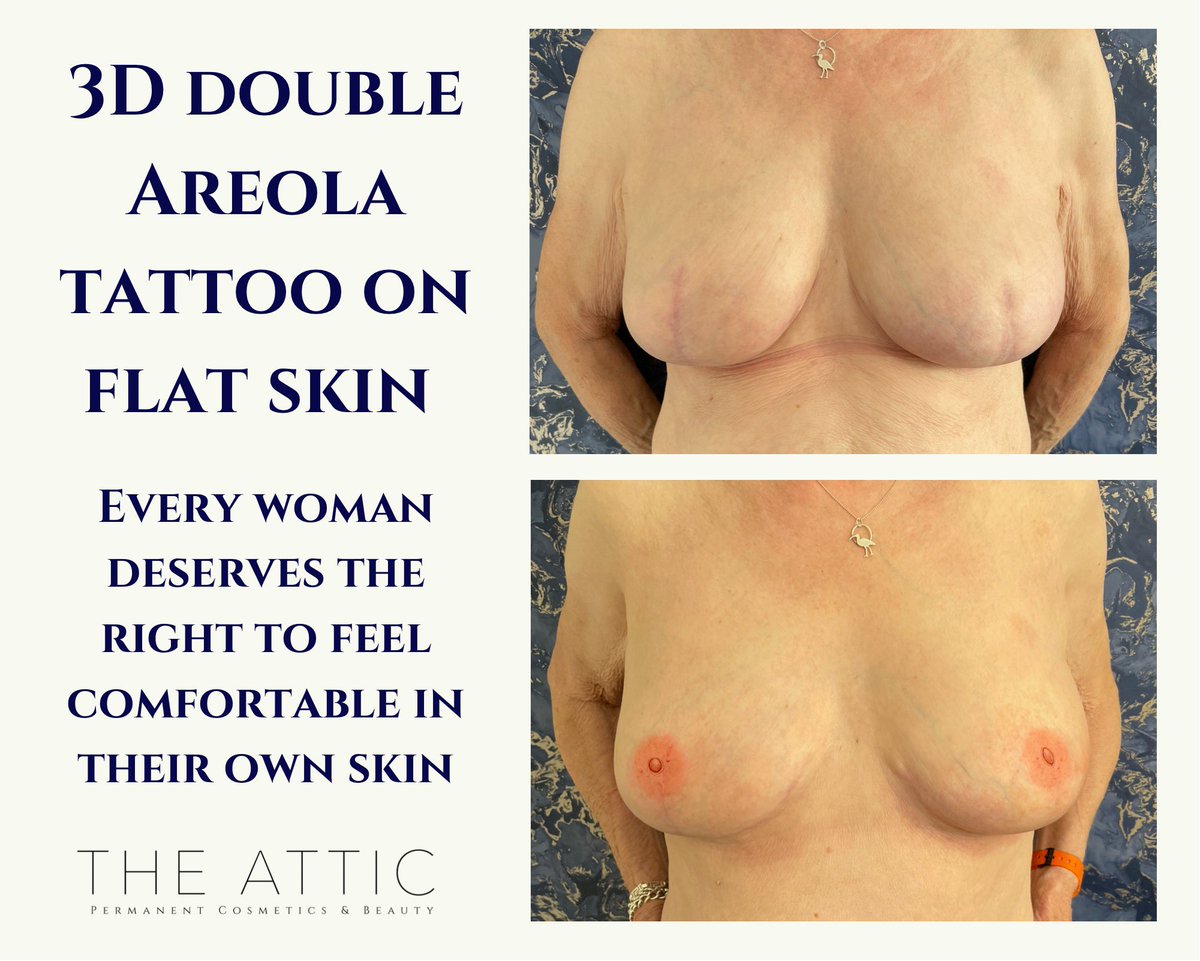 The Attic Permanent Cosmetics & Beauty (@attictanning) on Twitter photo My most favourite treatment to do 🌸
Free of charge clinics every month.
<a href="/primroseunit/">The Primrose Foundation</a> <a href="/mermaidcentre/">The Mermaid Centre</a> <a href="/RCHTWeCare/">Royal Cornwall Hospitals NHS Trust</a> @MacmillanSWest @Boo3doc <a href="/NuffieldHealth/">Nuffield Health</a> <a href="/BCCare/">Breast Cancer Now</a> @worldmedicalartists My most favourite treatment to do 🌸
Free of charge clinics every month.
<a href="/primroseunit/">The Primrose Foundation</a> <a href="/mermaidcentre/">The Mermaid Centre</a> <a href="/RCHTWeCare/">Royal Cornwall Hospitals NHS Trust</a> @MacmillanSWest @Boo3doc <a href="/NuffieldHealth/">Nuffield Health</a> <a href="/BCCare/">Breast Cancer Now</a> @worldmedicalartists