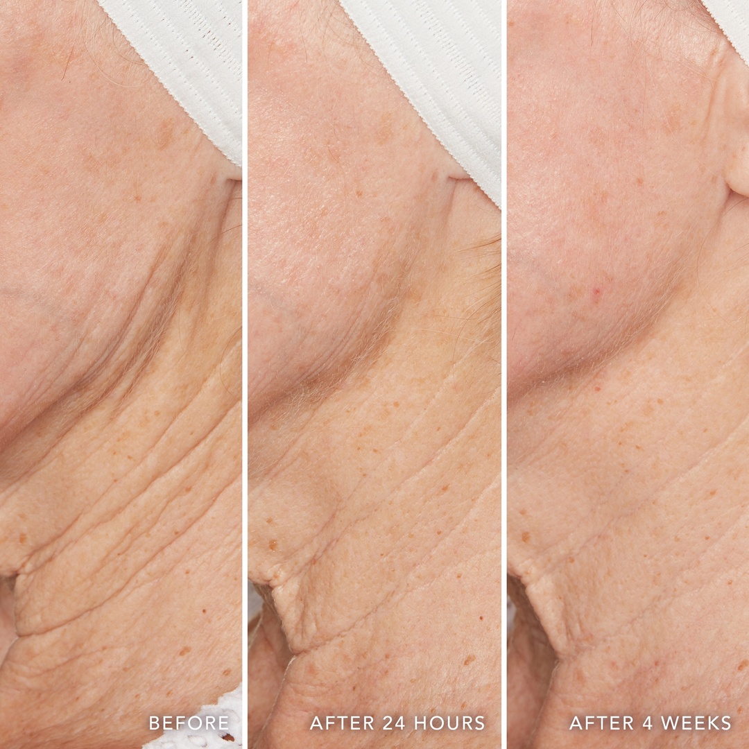 Gentle formula, powerful results. Swiping a Gentle Exfoliating Peel Pad across the face and neck, once every other day, can lead to #RealResults like these.