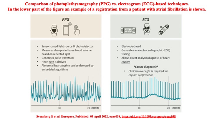 📌 Overview of digital heart rhythm devices and comparison of PPG vs. ECG-based techniques @EmmaSvennberg @Dominik_Linz @LuigiDiBiaseMD @mohitkturagam @DhirajGuptaBHRS @ManlioMarquez @leftbundle @SeguraCardio @netta_doc @DrMarthaGulati @iamritu @Hragy #EPeeps #Cardiotwitter