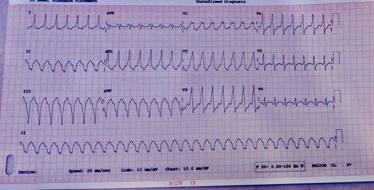 UlhasDr's tweet photo. Rhythm? (Dr Kshitij)
#ECG  @EPeeps_Bot
@syamkumarmd @MaruanCarlos @SchakrabartiEP @narrowQRS @Arritmias_HRC  @KanwarAulakh @abhishek_mbbs   @javadm20 @DidlakeDW @OnlyEcg1 @DrRajeshG1 https://t.co/iVd37MViO5