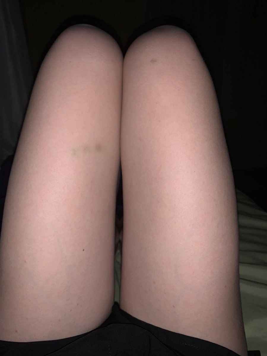 pro4naforme's tweet photo. my disgusting thighs #eatingdisorder #fat #anorexia #looseweight https://t.co/WiXf8NfYFY