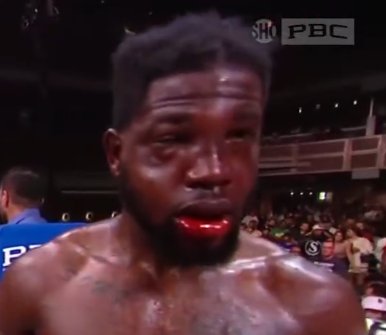 julianisjulius's tweet image. mírale que hinchazón y no podía cerrar la boca y no paraba de sangrarle por dentro la boca. 

Si eso no es una mandíbula fracturada me sorprendería mucho