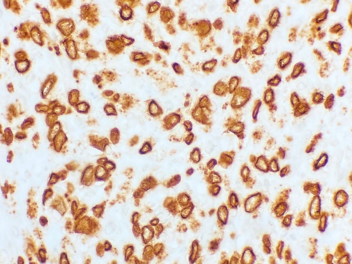 Epithelioid inflammatory myofibroblastic tumor.

An aggressive variant of IMT with a distinct nuclear or perinuclear pattern of ALK staining. 

This case had a RANBP2::ALK fusion. 

Read more here: PMID 21164297

#BSTpath