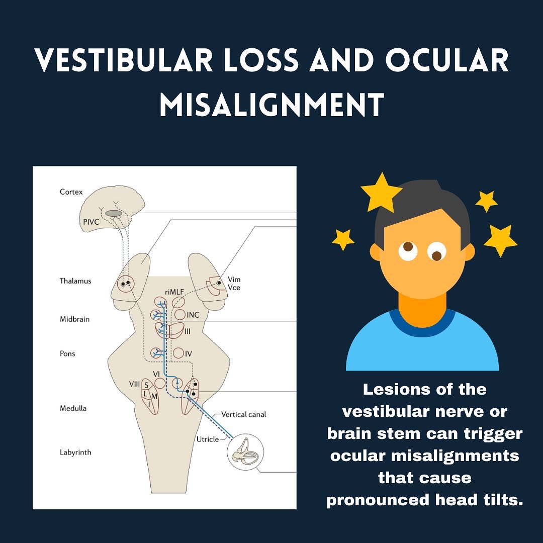 Keystoneneuro's tweet photo. Disruptions in the vestibular or eye movement pathways in the brain stem can create torsion of the eye.

If the brain doesn’t compensate well, this can be associated with feelings of imbalance, neck pain, and headaches https://t.co/oDyNAqZAcQ