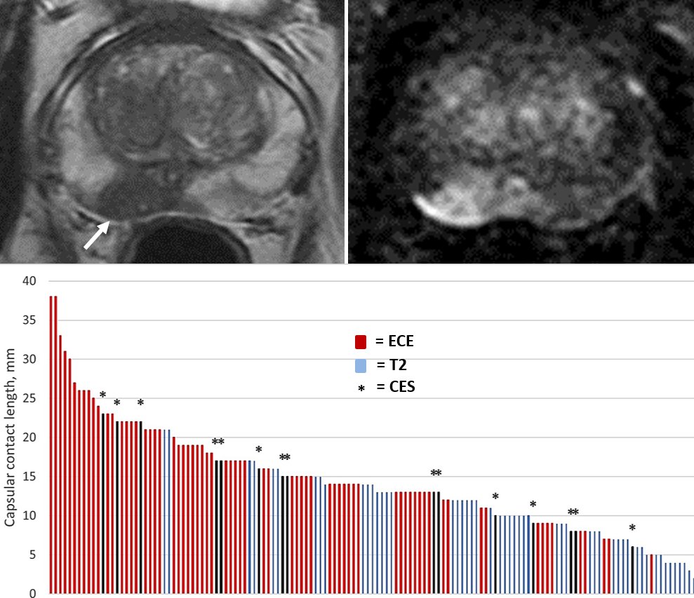 Tristan Barrett (@tristan_radiol) on Twitter photo "Capsular Enhancement Sign" when seen is highly specific for ECE. Distribution mimics tumour spread along perineural spaces where nerves vertically penetrate the capsule and maps the distribution of pathological PNI. <a href="/lkayat/">Leonardo Kayat Bit..</a> <a href="/radiolobt/">Baris Turkbey MD</a> <a href="/dr_becker/">Anton Becker</a> doi.org/10.1016/j.ejra… "Capsular Enhancement Sign" when seen is highly specific for ECE. Distribution mimics tumour spread along perineural spaces where nerves vertically penetrate the capsule and maps the distribution of pathological PNI. <a href="/lkayat/">Leonardo Kayat Bit..</a> <a href="/radiolobt/">Baris Turkbey MD</a> <a href="/dr_becker/">Anton Becker</a> doi.org/10.1016/j.ejra…