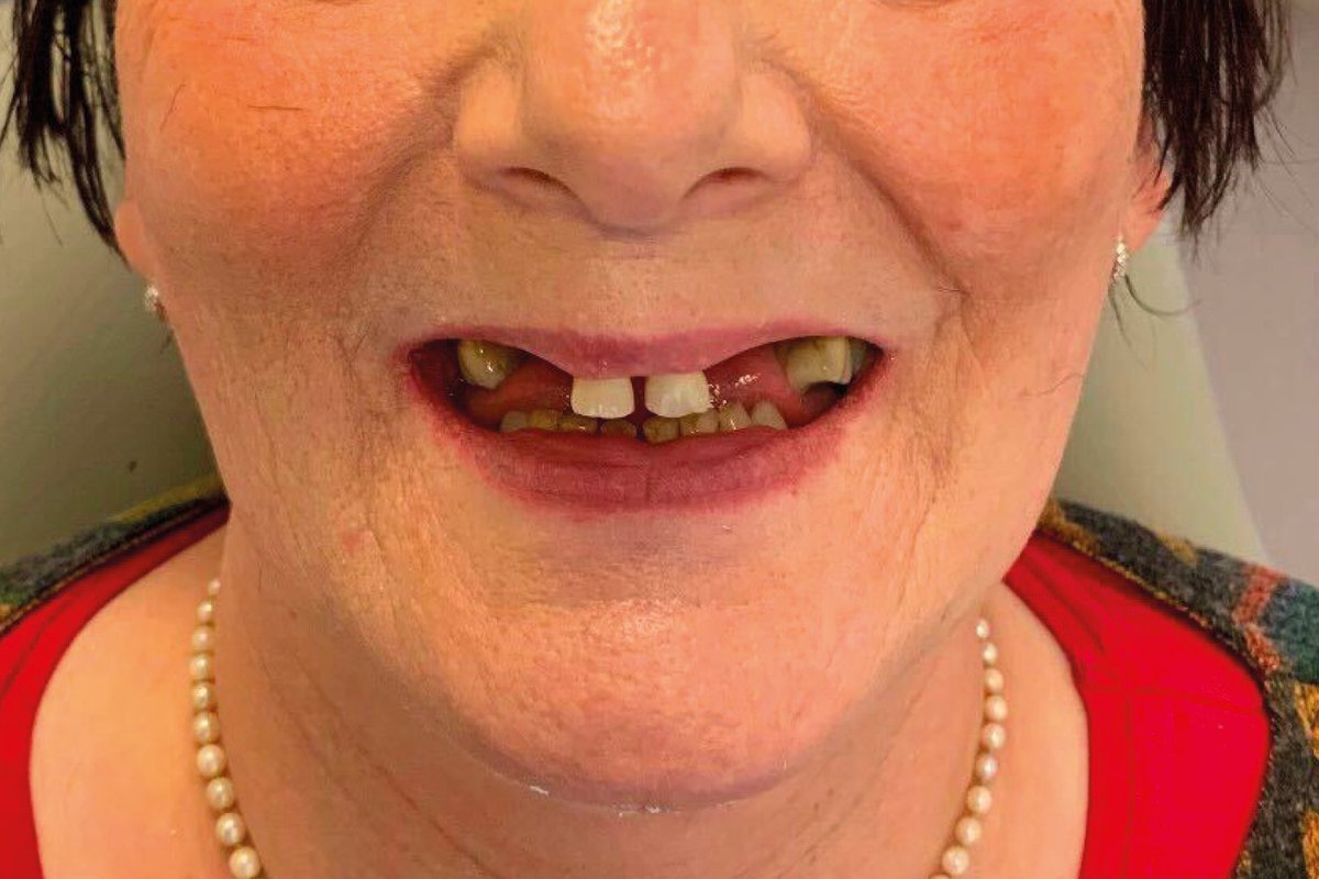 Dentistry's tweet photo. Join the best with full arch guided surgery;
Sharing his wealth of full arch guided surgery experience with Dentistry readers, James Hamill offers invaluable insight into why this treatment modality can’t be beaten ⬇️
https://t.co/eVN3uYUzoA
with @Quoris3D
#fullarchsurgery https://t.co/zeyeVjrbyn