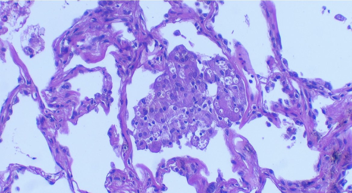 JCandidoXavier's tweet photo. #lung #histoplasmosis 

#path #PathTwitter #surgpath #MedTwitter #pathclues https://t.co/ZStgXBvqjv