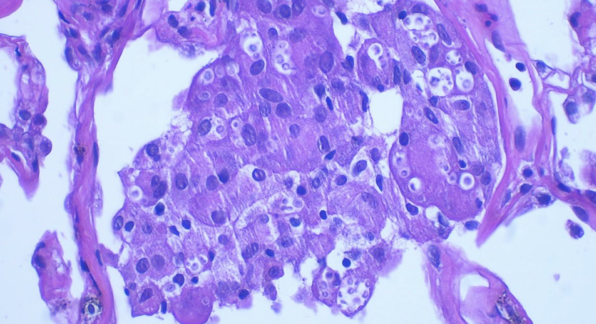 JCandidoXavier's tweet photo. #lung #histoplasmosis 

#path #PathTwitter #surgpath #MedTwitter #pathclues https://t.co/ZStgXBvqjv