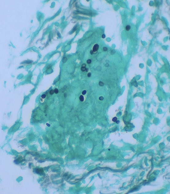 JCandidoXavier's tweet photo. #lung #histoplasmosis 

#path #PathTwitter #surgpath #MedTwitter #pathclues https://t.co/ZStgXBvqjv