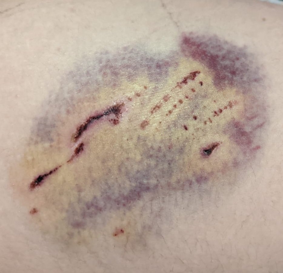 ImUncleEric's tweet photo. Dear @DurhamPolice this is one photo of 2 injury my daughter sustained by a dog last Friday. She has reported it, but no one has come out to see her injuries nor asked to see the pictures.
Why is this? https://t.co/0Hv8QkZvtH