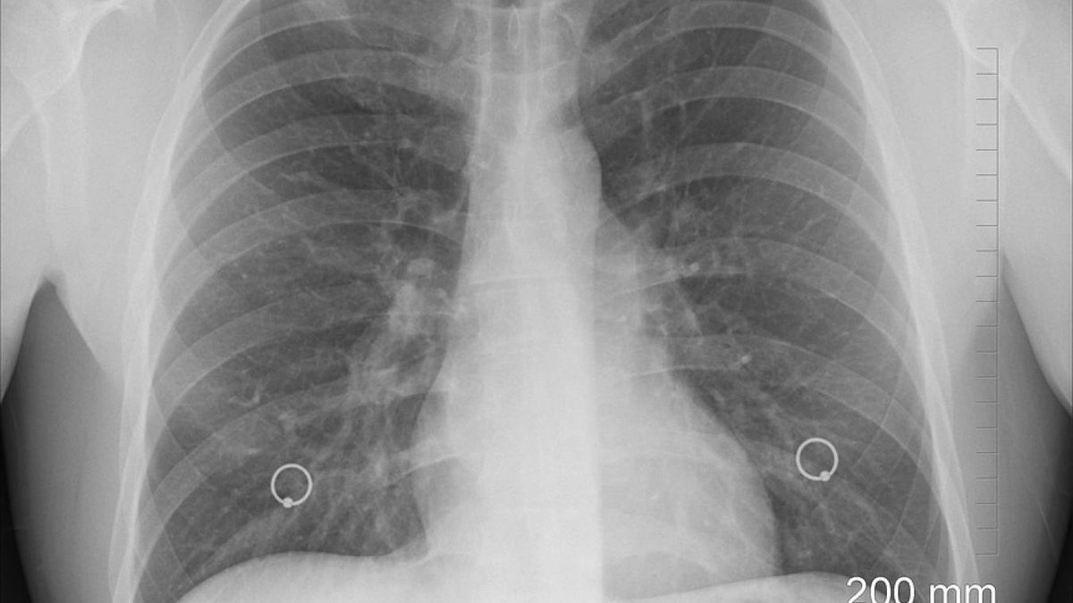 🫁 Atteint d’un cancer en phase terminale, un Américain a pu être sauvé grâce à l’exploit d’une double greffe de poumons. (20MN)