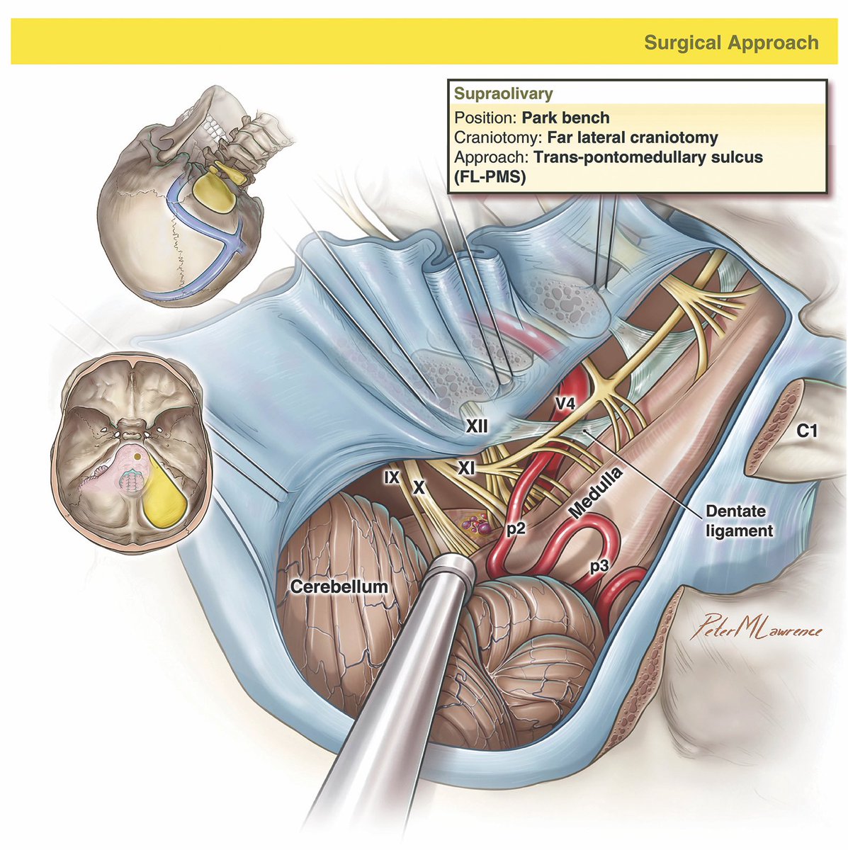 PeterMLawrence1's tweet photo. Illustration by @kristenlarson for a recently published article in @TheJNS on pontine cavernomas, by Dr. @mtlawton et al as part of the new #7Cavernomas series. It depicts Millard-Gubler syndrome (and yes, that patient is Dr. Joshua Catapano!). Article: https://t.co/4zMHRlHFm6 https://t.co/D6p94tO4bW