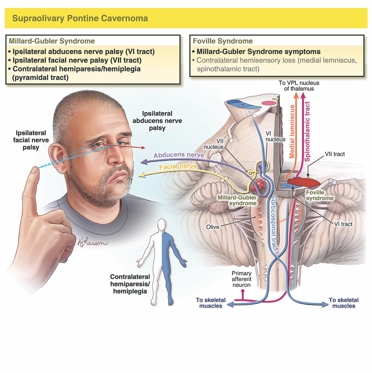 PeterMLawrence1's tweet photo. Illustration by @kristenlarson for a recently published article in @TheJNS on pontine cavernomas, by Dr. @mtlawton et al as part of the new #7Cavernomas series. It depicts Millard-Gubler syndrome (and yes, that patient is Dr. Joshua Catapano!). Article: https://t.co/4zMHRlHFm6 https://t.co/D6p94tO4bW