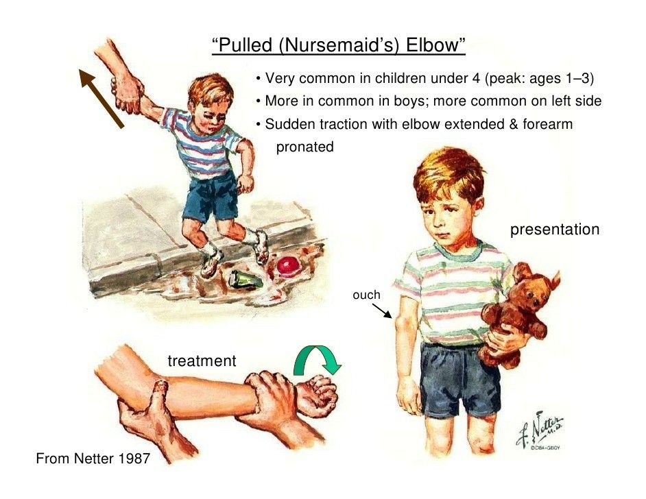 drchetanmd's tweet photo. A pulled elbow caused by sudden yanking or pulling a child - pulling the bones in elbow joint out of alignment is a common emergency.
Ice pack, pain relief and a realignment usually is quick and child is back to normal with mobility restored.
#elbowdislocation #childsafety https://t.co/aNMFrLs6aF