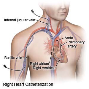 PatrickTitus's tweet photo. Update: Having a Right Heart Catherterzation done later today. Basically shoving a probe down my neck and in to my heart so they can poke around and see what’s up. Fun! 😵 https://t.co/ulDJ9w7zHy