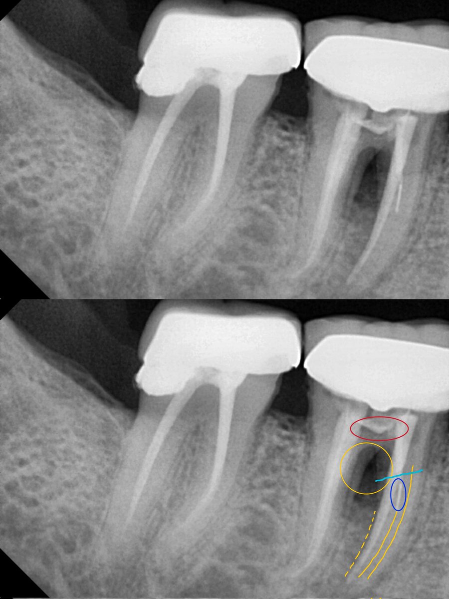 ChinmayVaze10's tweet photo. 5. Yellow lines - Missed ML and incomplete fill with MB
6. Blue line - Mesial Root fracture. 
Prognosis - Hopeless
Rx - Extraction 
#everydaydentistry #microdentistry https://t.co/2spEhQ86mJ