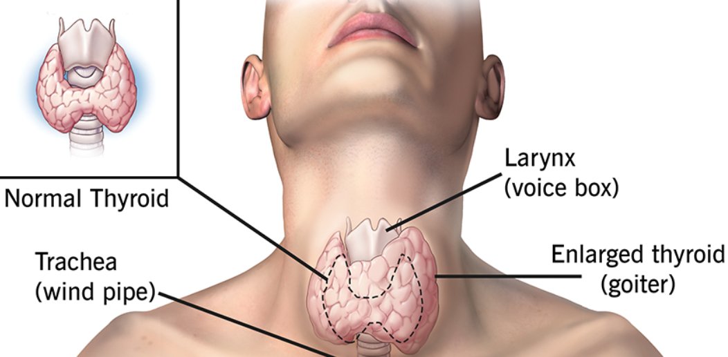 NutritionImmuno's tweet photo. Do you struggle with Hashimotos- an autoimmune thyroid disease. Changes to your diet and lifestyle can help support your immune system and thereby help your thyroid function. #hashimotos #thyroid #autoimmune #diet #lifestyle #weightloss #fatigue #energy 

https://t.co/jDTd5QaDsJ https://t.co/4xePGZMtvk