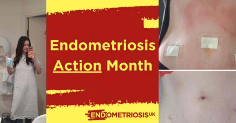 OlympusMedUKIE's tweet photo. As #EndometriosisActionMonth draws to a close, Nola Hedderman, an Olympus employee, shares her personal experience of living with #endometriosis, to help increase awareness of the condition and highlight the impact it can have

You can read her story here: https://t.co/7XJNMI5ukC