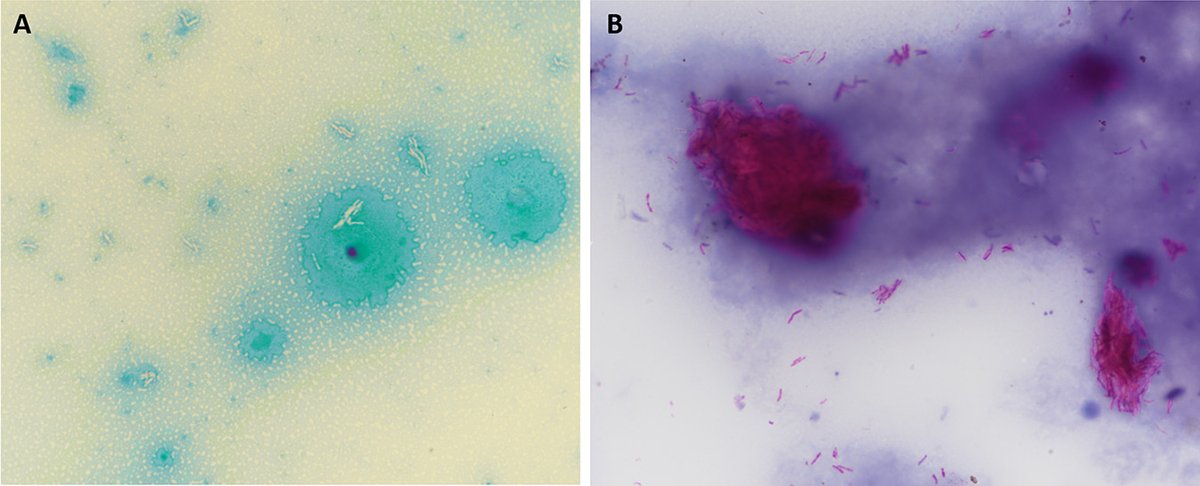 Photo Quiz! A 52-Year-Old Liver Transplant Patient with Chronic Diarrhea Stool submitted for O and P. Left - modified trichrome. Right - modified acid fast for coccidia What do you suspect? What would you do next? bit.ly/3JJiSxX @ASMicrobiology