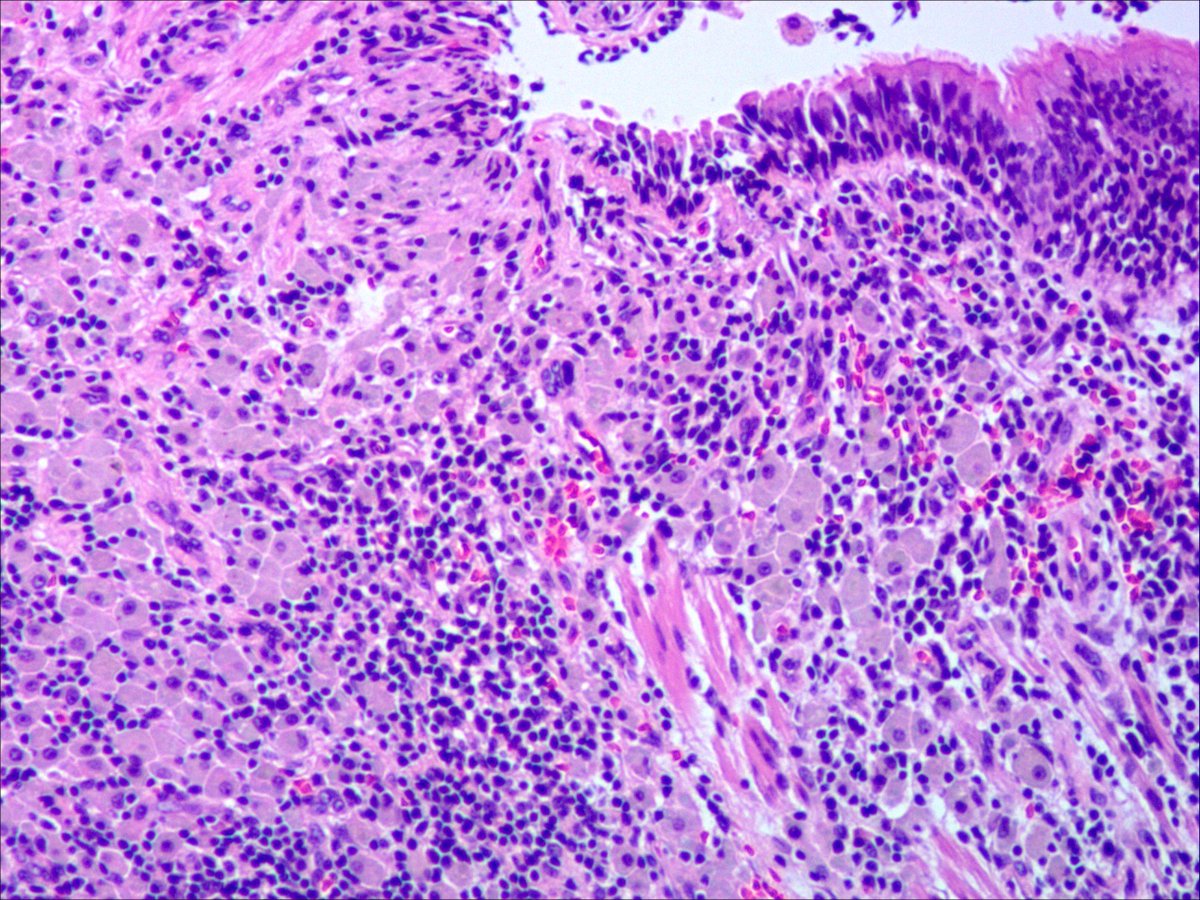 dnarna111's tweet photo. 59 yo F. Chest X-ray showed an irregular cyst shadow of the right upper lobe, without diarrhea, without Inflamed joints.
#thoracicpath #pathology
@smlungpathguy  @Path_Matt 
Whipple's disease？ https://t.co/BefdkrADgl