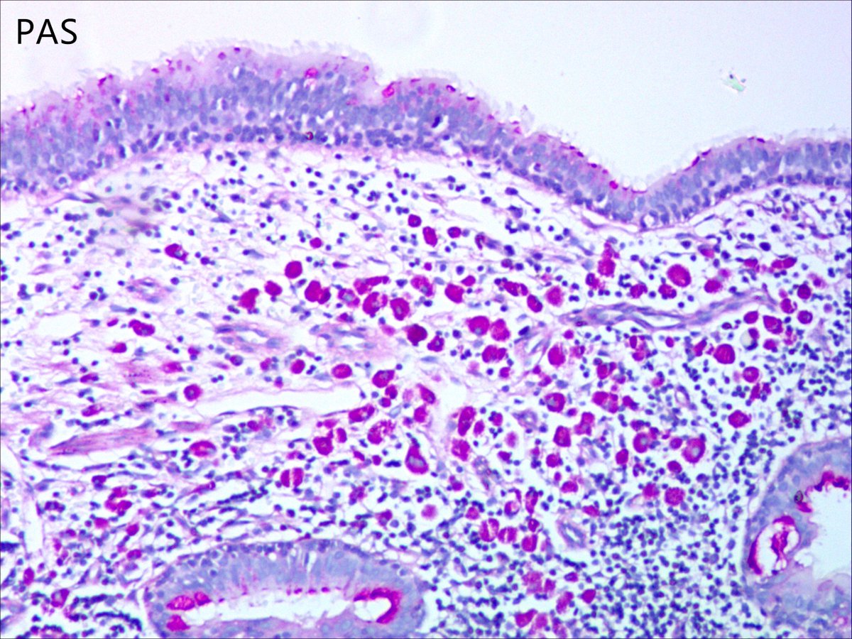 dnarna111's tweet photo. 59 yo F. Chest X-ray showed an irregular cyst shadow of the right upper lobe, without diarrhea, without Inflamed joints.
#thoracicpath #pathology
@smlungpathguy  @Path_Matt 
Whipple's disease？ https://t.co/BefdkrADgl