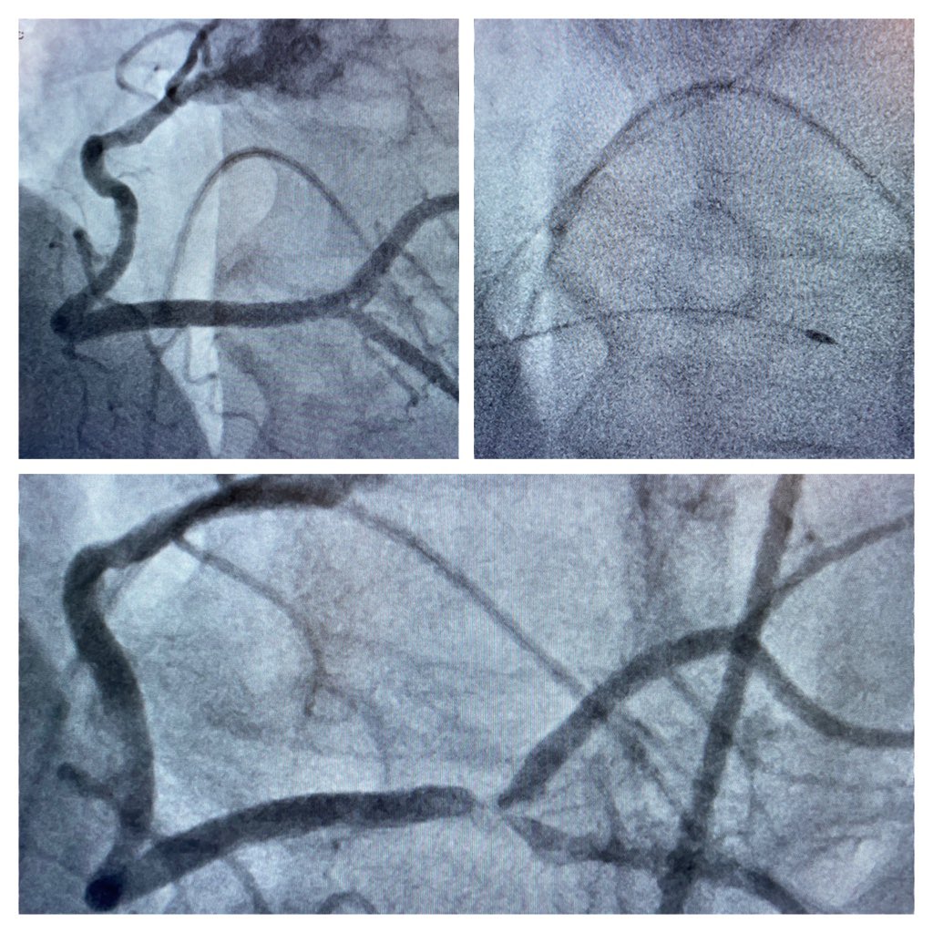 AndWierucki's tweet image. RCA stenosis Medina 1-1-1. Fielder XT-R, Supercross FT, Rotapro 1,25 mm. NSE Alpha 3,0/13 mm. TAP with Xience ProS 3,0 23 mm in RCA/RIVP and 3,0/18 mm in RPLS. Final KB. POT with Sapphire NC 24 4,0/8 mm. @BotPci #Rotapro @Obisht @KPujdak @KardiologieHH @klinki_hh @VRubesch