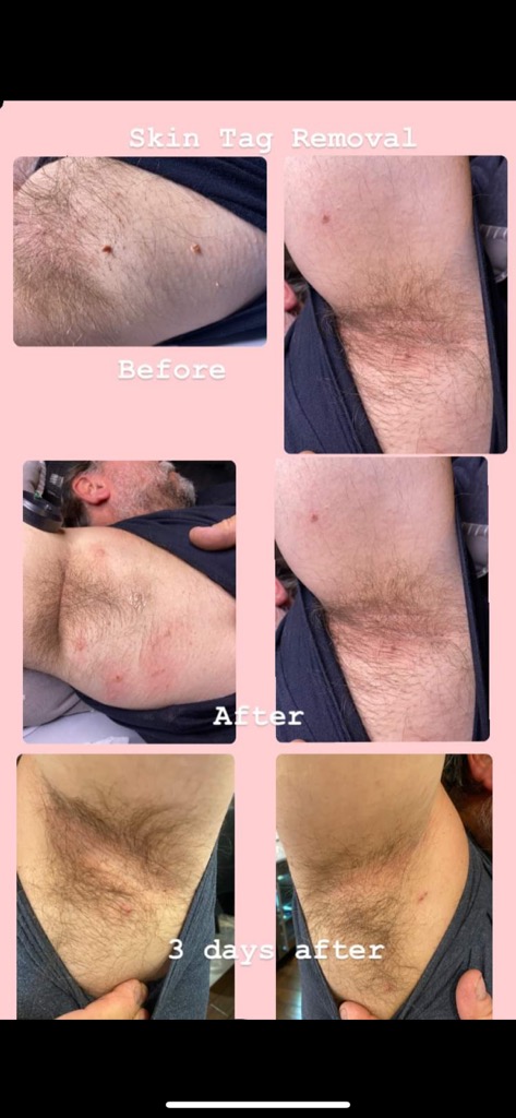 revivifymedispa's tweet photo. This April 8th we are holding a Skin Tag Removal clinic with Nurse Amanda. I know we are sick and tired of skin tags making us feel not our best!

#skintagremoval #skintagremoval  #skintagtreatment #facialtreatment #skintreatment #Kitchener #waterloo #cambridgeontario #stratford https://t.co/swGkDM5Eli