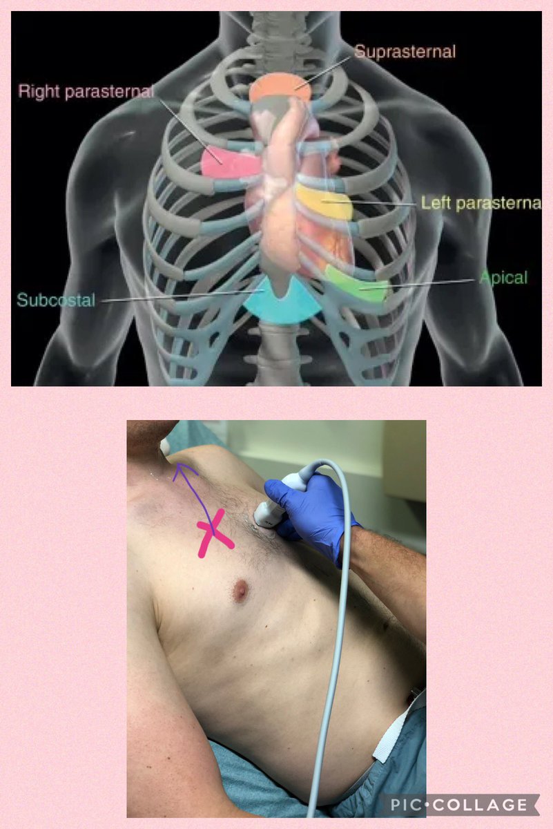 With patient in right lateral position Find PLAX Slide up ⬆️ rib space to Ao focus view Cross to the ⬅️ right side of the sternum Rotate 🔁 clockwise with marker at around 12/1oclock