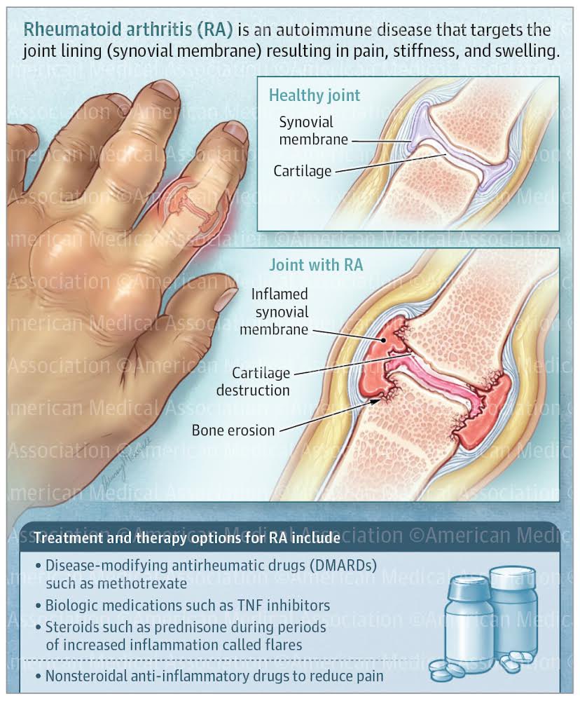 maxwell_visuals's tweet photo. I’m excited to share my first illustration as the JAMA intern! This piece is for the patient education page titled “What is Rheumatoid Arthritis?” Click below to learn more! https://t.co/1AlGdvHVyg