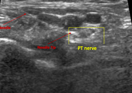 Bilateral posterior tibial nerve block for phantom toe pain. Post block, pain decreased by 70% on one side, and 50% on the other. @UTHouston_IR @ahmed_kamel_ir @RodZvavanjanja @jdprologo @AlanAlperMD  #IamIR #minimallyinvasiveprocedures #collaboration #interventionpain