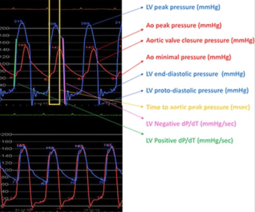 BURZOTTA_F's tweet photo. Did you use to look carefully at the haemodynamics during your #TAVI procedures??? Which correlations with echo findings before and after??? Here is the descrption of what we found. Great thanks to all our #VHD team! https://t.co/lciRjBn5Qm