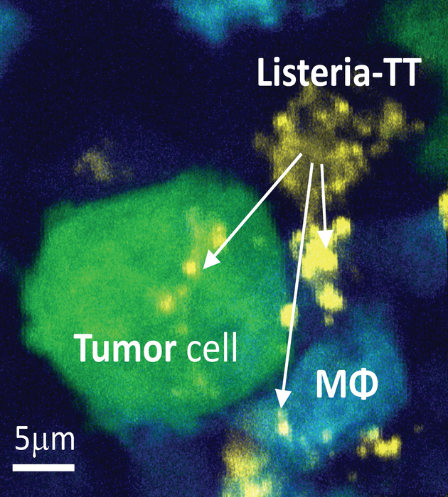 Science Translational Medicine (@sciencetm) on Twitter photo A microbial #immunotherapy that leverages pre-existing #tetanus vaccine immunity shrinks #PancreaticCancer tumors in mice – offering an approach that may overcome the poor performance of immunotherapies against this deadly cancer. <a href="/EinsteinMed/">Albert Einstein College of Medicine - Official</a> <a href="/BensonCS21/">Benson Chellakkan Selvanesan</a> fcld.ly/w46tnio A microbial #immunotherapy that leverages pre-existing #tetanus vaccine immunity shrinks #PancreaticCancer tumors in mice – offering an approach that may overcome the poor performance of immunotherapies against this deadly cancer. <a href="/EinsteinMed/">Albert Einstein College of Medicine - Official</a> <a href="/BensonCS21/">Benson Chellakkan Selvanesan</a> fcld.ly/w46tnio