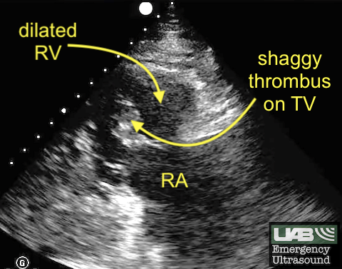 UAB_Sono's tweet photo. @UABEmergencyMed @UABCardiology @MustafaAhmedMD @ACEP_EUS @coreultrasound Thrombus-in-transit with dilated RV. Pt had massive bilateral PTE with right heart strain. Aspiration thrombectomy performed with large thrombi removed (pic). Pt dc'd in good condition 10 d later on apixaban. https://t.co/bl7ScYjzjo