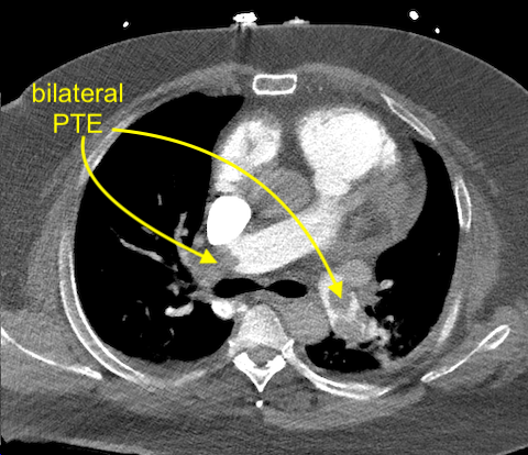 UAB_Sono's tweet photo. @UABEmergencyMed @UABCardiology @MustafaAhmedMD @ACEP_EUS @coreultrasound Thrombus-in-transit with dilated RV. Pt had massive bilateral PTE with right heart strain. Aspiration thrombectomy performed with large thrombi removed (pic). Pt dc'd in good condition 10 d later on apixaban. https://t.co/bl7ScYjzjo