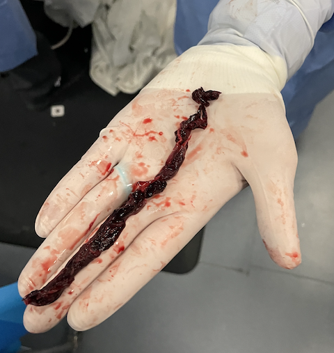 UAB_Sono's tweet photo. @UABEmergencyMed @UABCardiology @MustafaAhmedMD @ACEP_EUS @coreultrasound Thrombus-in-transit with dilated RV. Pt had massive bilateral PTE with right heart strain. Aspiration thrombectomy performed with large thrombi removed (pic). Pt dc'd in good condition 10 d later on apixaban. https://t.co/bl7ScYjzjo