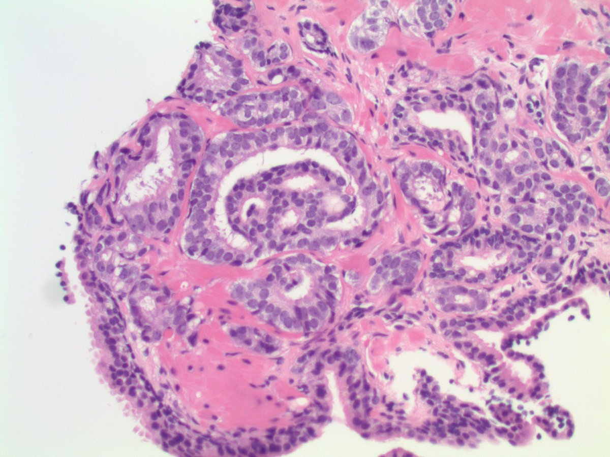 slusagar's tweet photo. #GUpath #grayzonepath prostate bx
(no "right" answer, but good depiction & case for discussion)
📸🔬 here
⏬
poll to follow https://t.co/nf2LARHq58