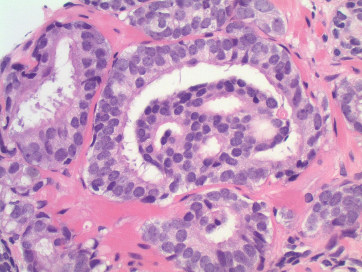 slusagar's tweet photo. #GUpath #grayzonepath prostate bx
(no "right" answer, but good depiction & case for discussion)
📸🔬 here
⏬
poll to follow https://t.co/nf2LARHq58