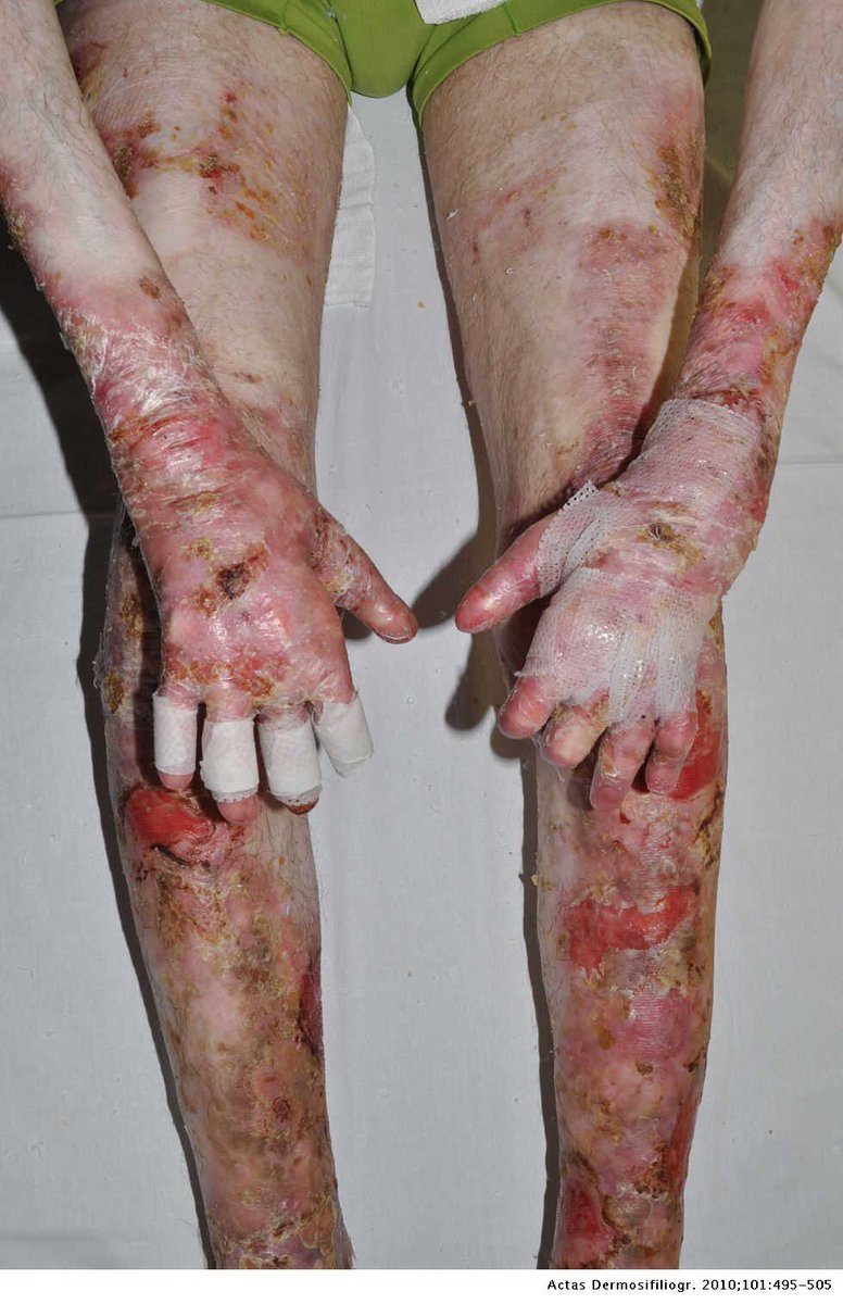 Ayer se publicó un artículo en el que, mediante una terapia génica 🧬 con vectores virales 🦠, se lograba curar heridas de personas con epidermólisis bullosa. Son los conocidos como “niños mariposa” 🦋 por la fragilidad de su piel. Os cuento de que va 🧵👇🏼