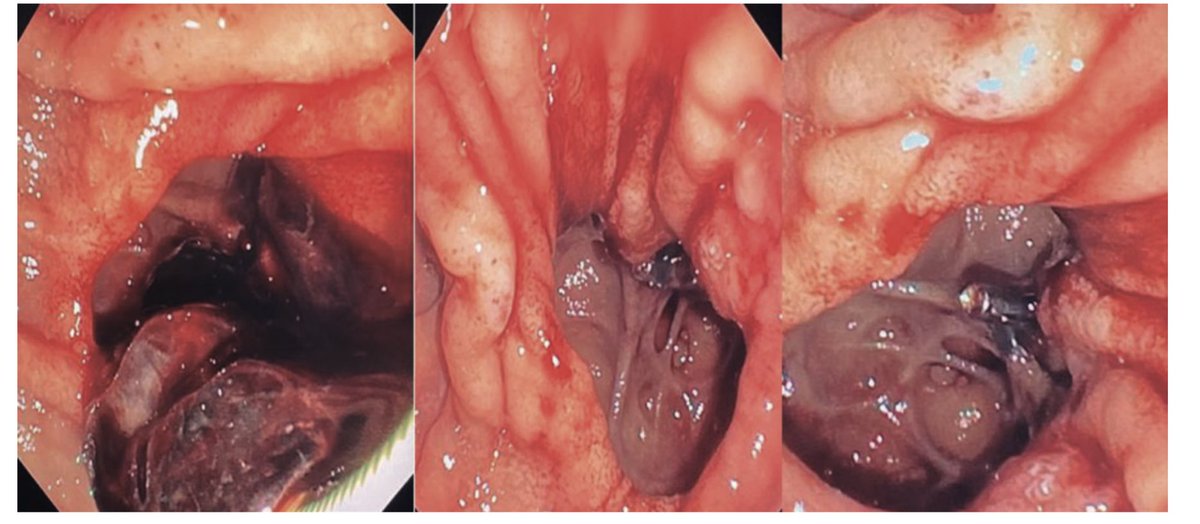 REED Upper gastrointestinal bleeding due to duodenum diverticulum: a challenge for the endoscopist reed.es/ArticuloFicha.…

Enhorabuena a nuestra R3! Menudo año de publicaciones que lleva! Y por muchas más <a href="/ojeda_asun/">Asun Ojeda Gómez</a> <a href="/digestivoHGUE/">Digestivo HGU Elche</a>