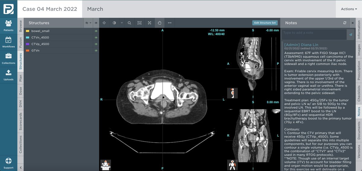 eContourRadOnc's tweet photo. 🎉 #C3RO Case 4 (GYN) is well underway! Don't forget to get your contours in by April 17th 📅! If you haven't started yet, don't wait! ⏰
⚙️ We've resolved all technical issues from system update. If you encounter any issues, please 📧 support@econtour.org.
#meded #radonc https://t.co/c8imHjHZZG
