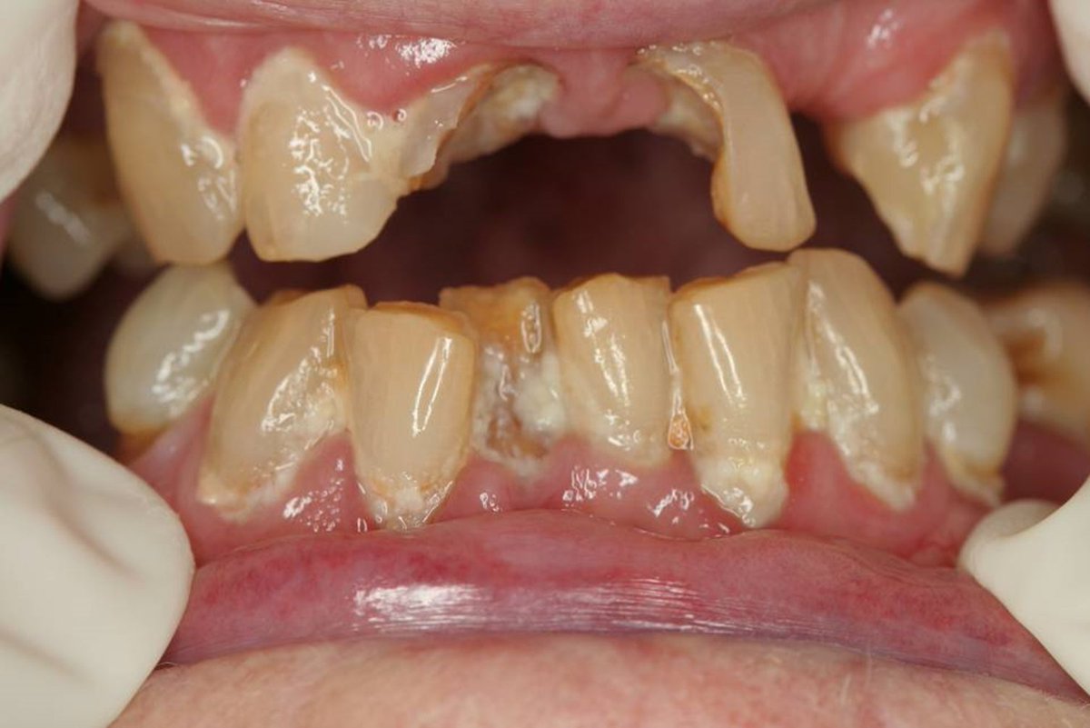 Matt_Hopcraft's tweet photo. Day #2 [daily photo of aged care oral health]
Tooth decay in multiple teeth, significant plaque &amp; gum disease. Pain, embarrassed appearance, difficulty eating. Not a short term issue.
Solution: Medicare Seniors Dental Benefits Scheme
#MyMouthMatters #dental #HealthBudget2022 https://t.co/aSy8kf8qET