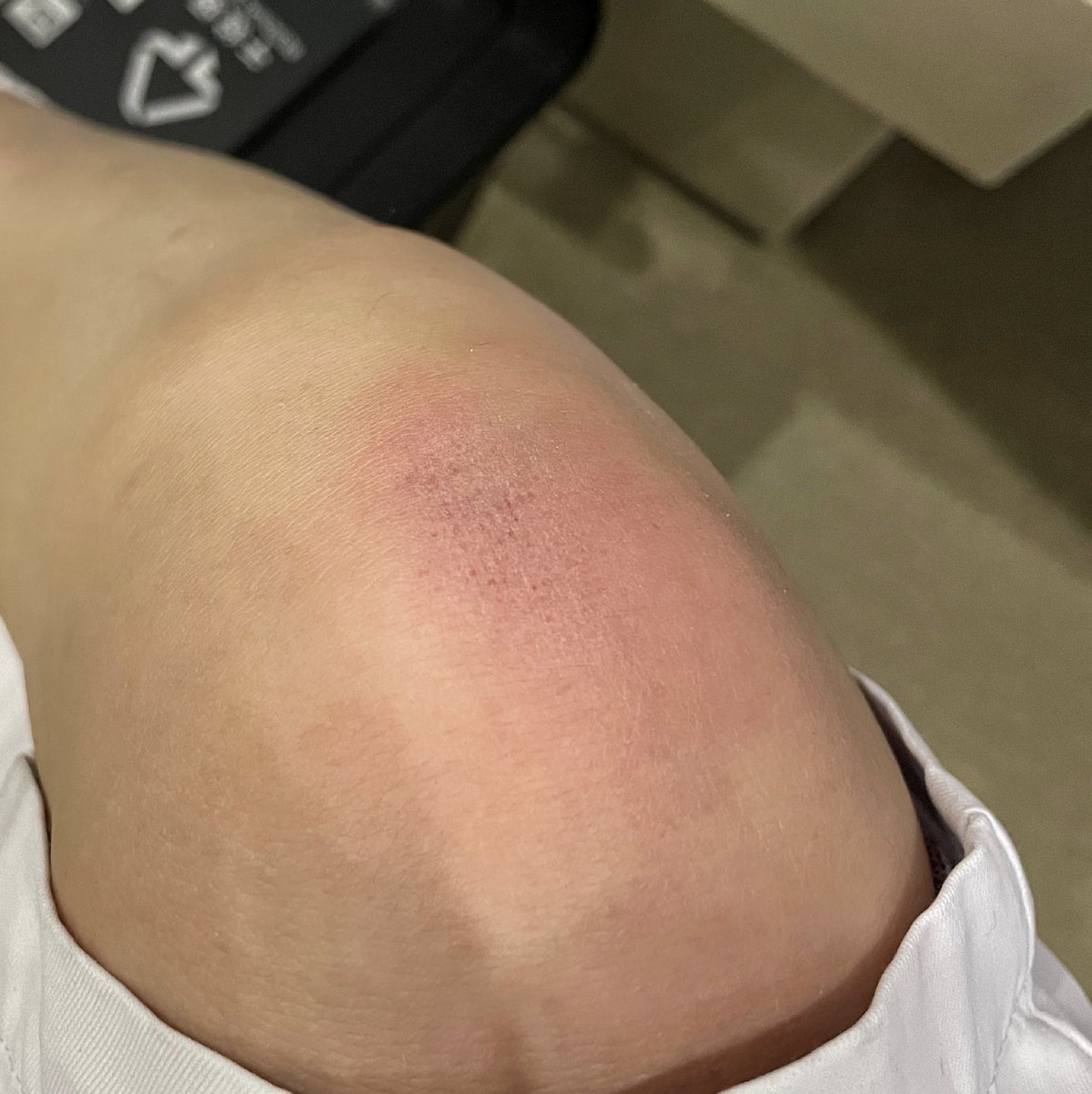 XxBonte's tweet photo. 别的m的伤都是被SP来的，我的是一天一跤摔的 差距怎么那么大
#小母狗 #文爱 #骚逼 #露出 #制服诱惑 #护士制服 #原味棉袜 #原味 #深喉 https://t.co/l9tF4Fp9Pi