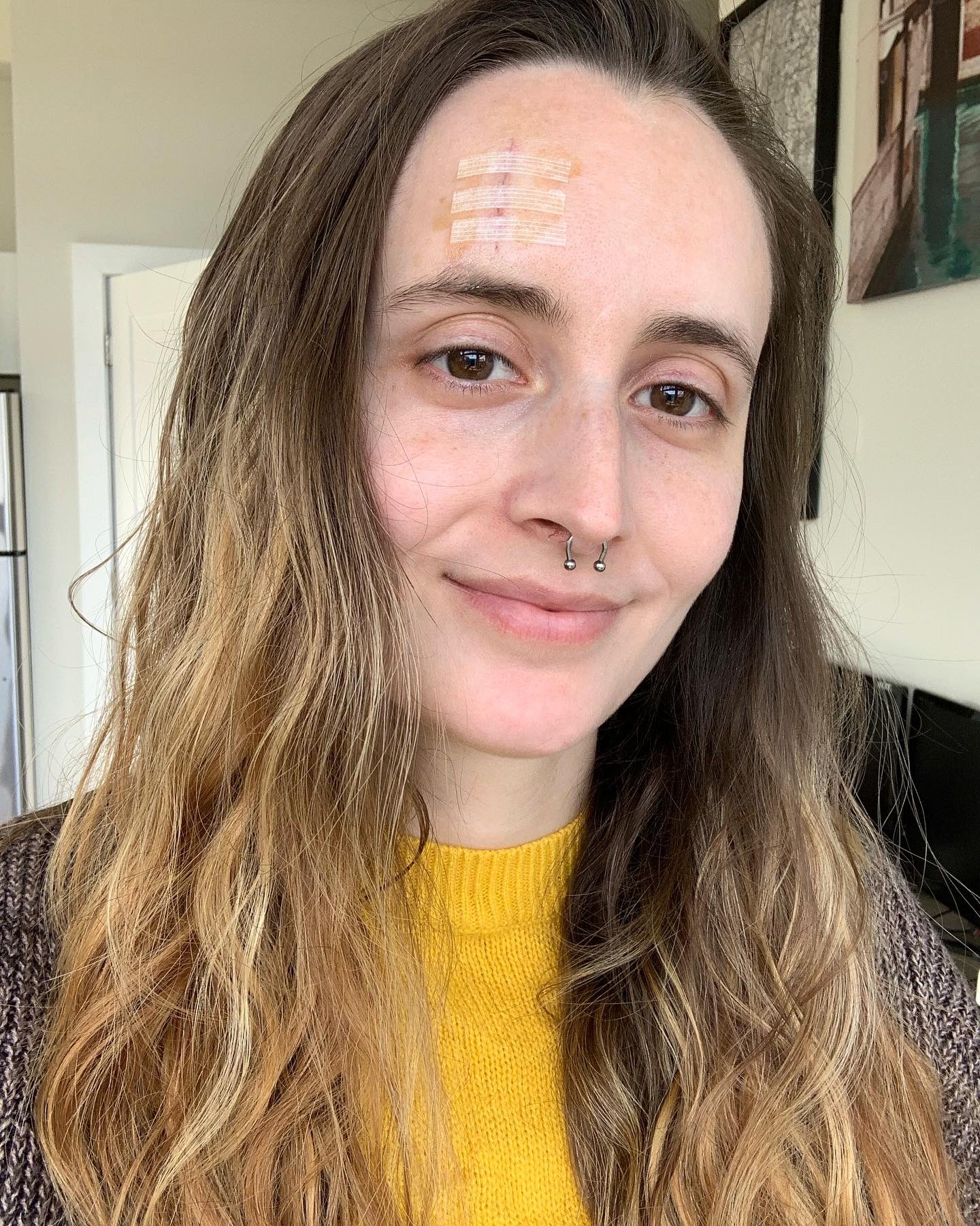 Saraॐ on Twitter "Got my stitches out today, so I decided to get bangs