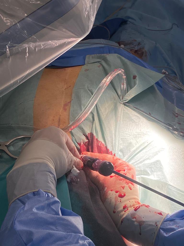 goncascoutinho's tweet photo. Suprasternal direct access TAVR, through braquiocephalic artery, in a 86yrs old patient, w/ previous CABGx3. Discharge in POD2. @marcocostacard @DrManuelSantos @JoanaDelgadoSi1 @luispcleite @AnaVeraMarinho1 https://t.co/1XBv0JYVHZ
