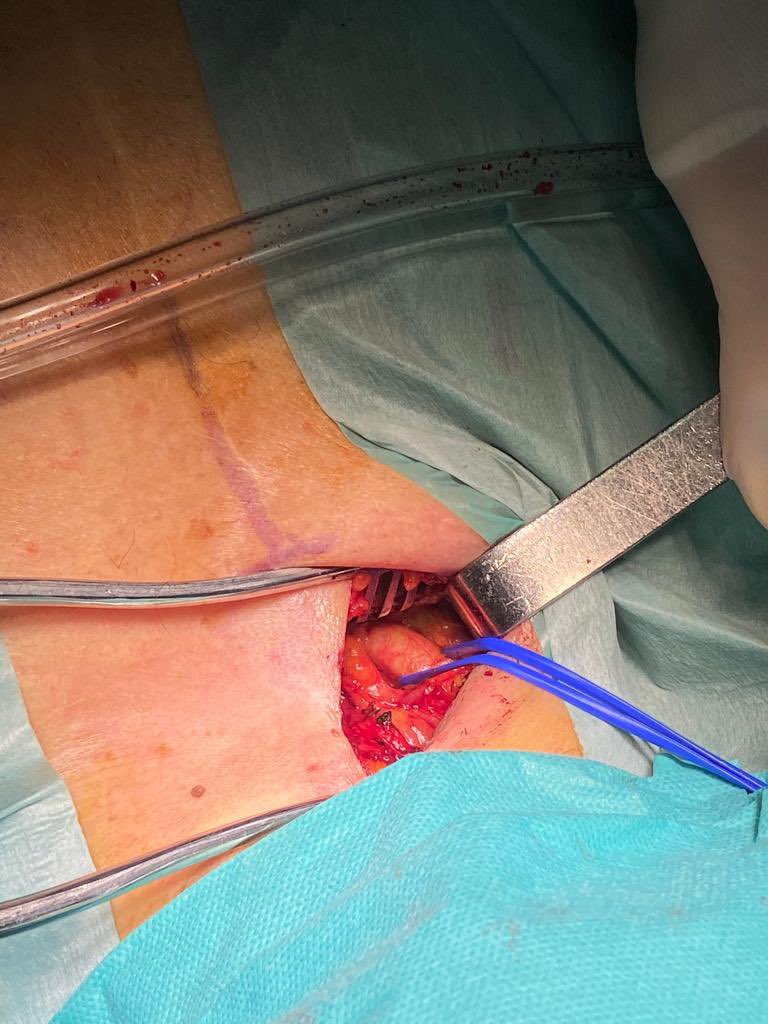 goncascoutinho's tweet photo. Suprasternal direct access TAVR, through braquiocephalic artery, in a 86yrs old patient, w/ previous CABGx3. Discharge in POD2. @marcocostacard @DrManuelSantos @JoanaDelgadoSi1 @luispcleite @AnaVeraMarinho1 https://t.co/1XBv0JYVHZ