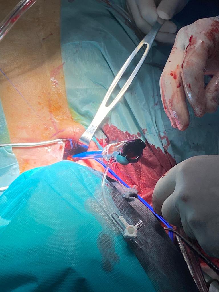goncascoutinho's tweet photo. Suprasternal direct access TAVR, through braquiocephalic artery, in a 86yrs old patient, w/ previous CABGx3. Discharge in POD2. @marcocostacard @DrManuelSantos @JoanaDelgadoSi1 @luispcleite @AnaVeraMarinho1 https://t.co/1XBv0JYVHZ