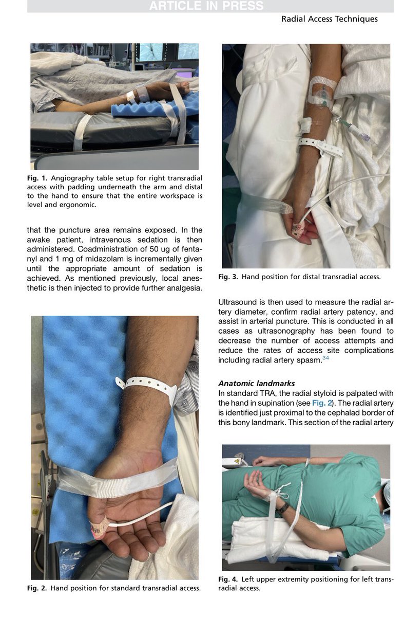 evanluthermd's tweet photo. Want to convert your practice to #radialfirst but don’t know where to start? Here is a summary of the tips and tricks to make it happen! Special thanks to Josh Burks for posing for the camera! @VaidyaGovind15 #radialAccess #neuroIR https://t.co/tbtgIHgC41