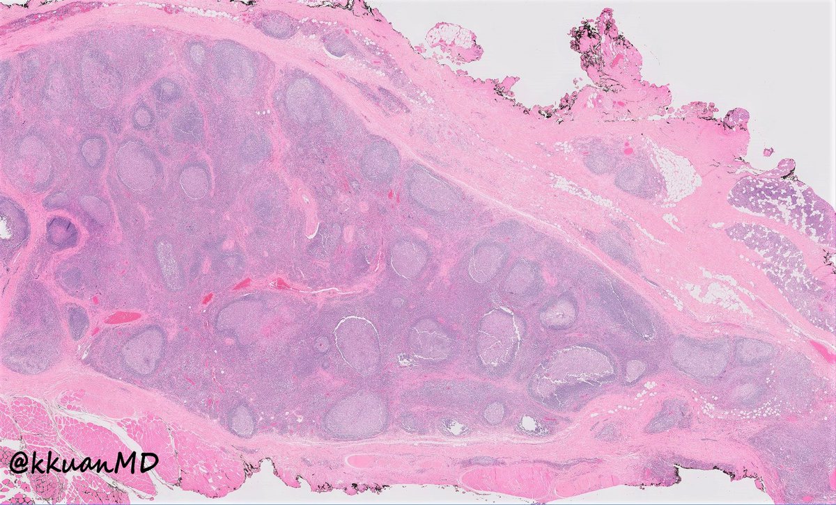 Pre-auricular nodule x 1month from 31yo patient, no other complaint. #pathtwitter #surgpath #ENTpath #hemepath #pathboards <a href="/EinsteinPath/">Einstein Montefiore Pathology</a> <a href="/ridin_bk_MD/">Ridin Balakrishnan, MD</a> <a href="/HansiniMD/">Hansini Laharwani</a> <a href="/SibaElHussein/">Siba El Hussein, MD</a> <a href="/MitulModiMD/">Mitul B. Modi, MD</a> <a href="/TristanRutland7/">Tristan Rutland MBBS FRCPA IFCAP</a> <a href="/JMGardnerMD/">Jerad Gardner, MD</a> <a href="/KMirza/">Kamran Mirza MD PhD - کامران مرزا</a>