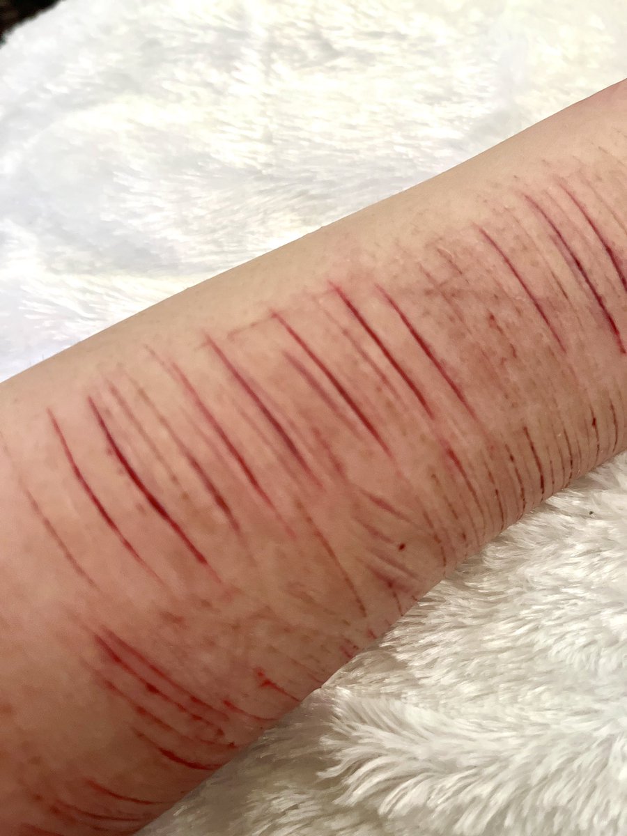 ri__m01's tweet photo. ちょっと深めだったかも
腕がきたない
 #リスカ  #アムカ https://t.co/qBE0NYrezk
